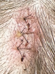 AIBU to think my stitches may be infected?