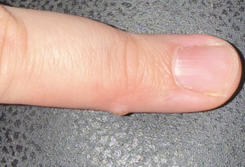 Wart