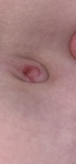 Half outie belly button problem? Pictures be warned