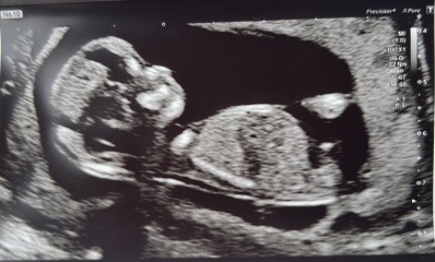 Boy or girl? Nub theory