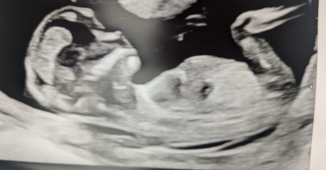Gender guesses (13 week scan)