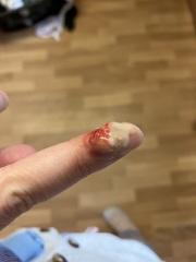 I think I have a cyst on top of my cyst (pics)