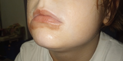 Can I have some advice about rash around dd's mouth please?