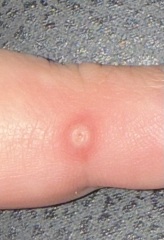 Wart