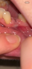 Does anyone know what this is post tooth extraction?