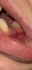 Does anyone know what this is post tooth extraction?