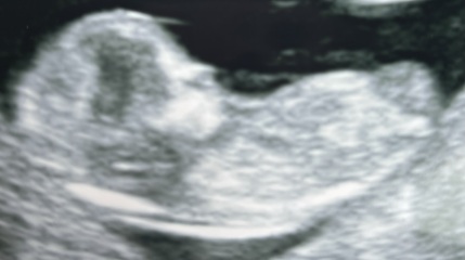 12 and 13 week scan