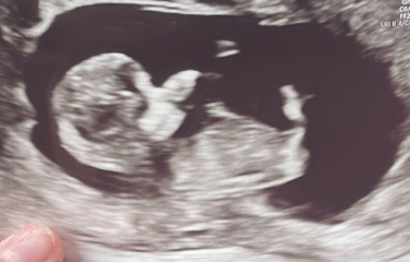 Boy or girl scan