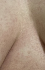 Between boobs sweat itch