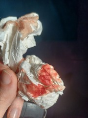 *** tmi*** bleeding at 11 weeks