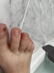 Toenails .. fungus... one toenail broken off