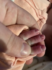 Newborn nail issue