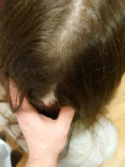 I think I have a cyst on top of my cyst (pics)