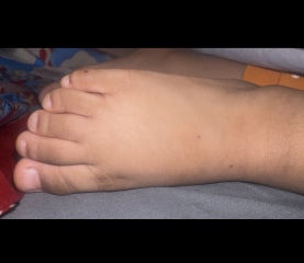 Small spots on child’s feet have turned dark