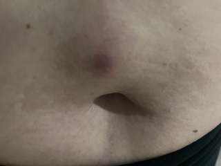 What is this lump