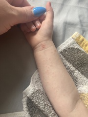 Hand foot & mouth or Chickenpox?