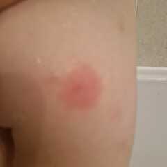 Chicken pox or bug bites