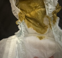 Advice please - warning nappy pictures included