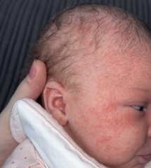Baby acne?