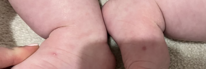 6 month old pimples/blisters??