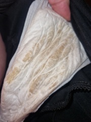 *TW* *graphic photos* discharge (doesn't look like plug)
