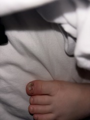 Does this warrant a&e, infected toe?