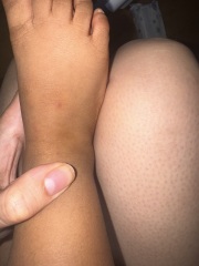 Small spots on child’s feet have turned dark