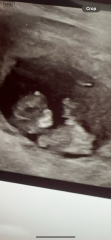 Scan head shape concern