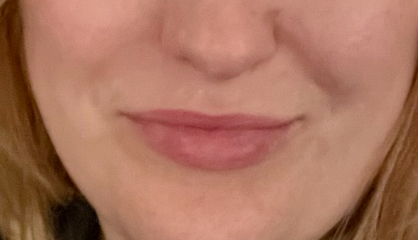 To be glad that people are realising the effects of filler!