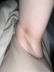Lump in armpit - need advice!
