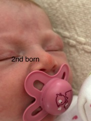 Sore on newborns nose