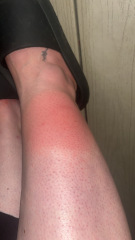 Is this bite concerning