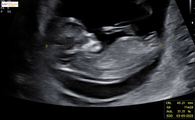 Worried about NT- 11week scan