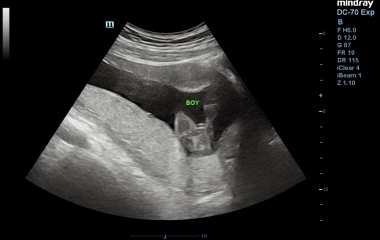 Gender on my ultrasound ??