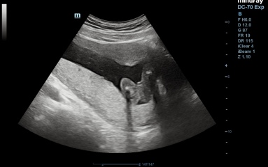 Gender on my ultrasound ??
