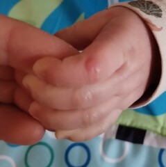 6 month old pimples/blisters??