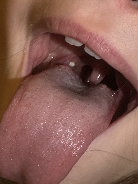 What is this? Tonsillitis but can’t be!