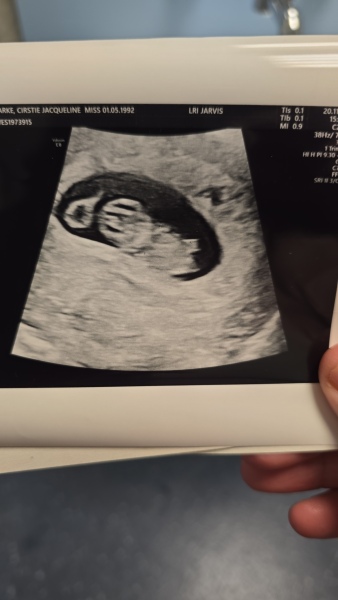 Two sacs but one heartbeat? Experiences please :-)