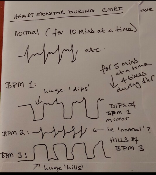 Can anyone explain heartbeat scan 'shapes' please?