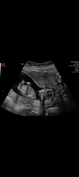 14 weeks and 3 days