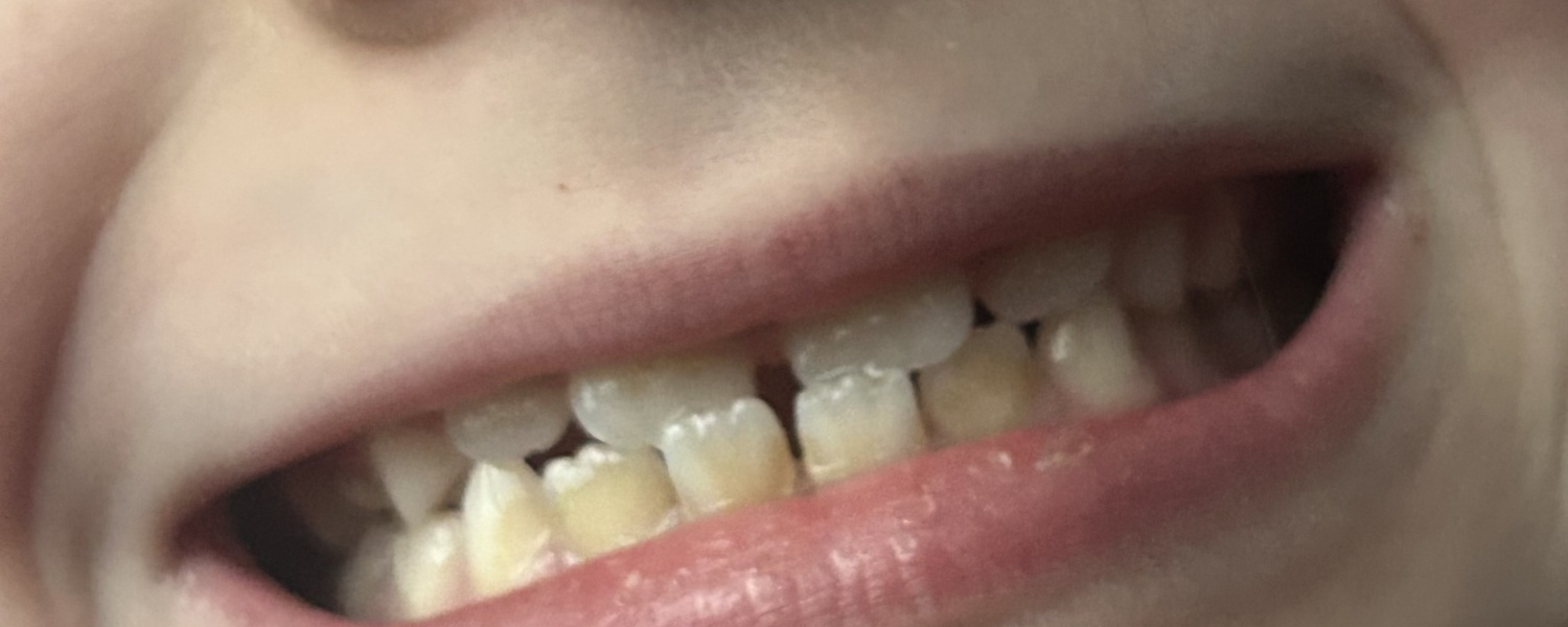 Why are my child’s teeth like this?