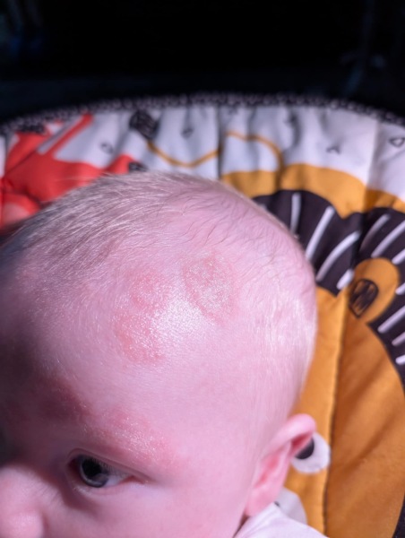 What is this on my sons head???