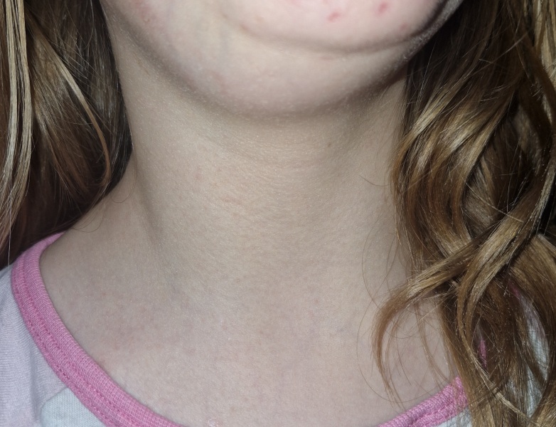 Lymph node