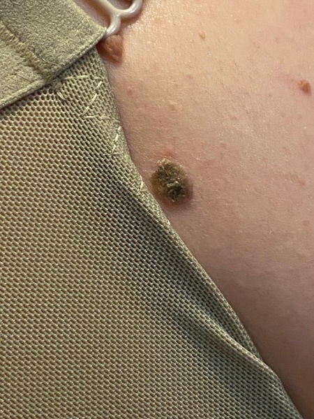 Iffy looking mole?