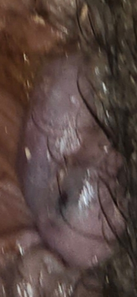 GRAPHIC photo. Is this external haemorrhoid infected?