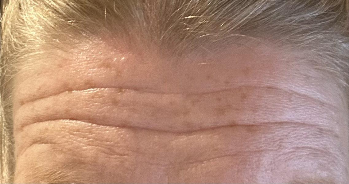 Deep forehead wrinkles