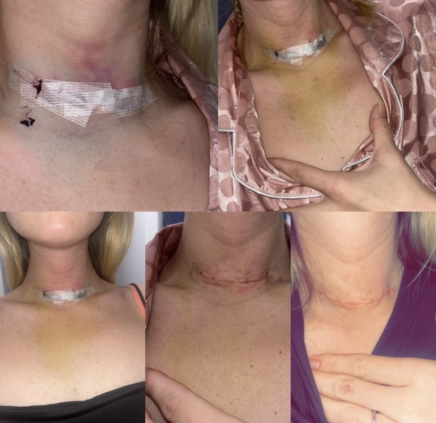 Graves’ disease overactive thyroid , surgery soon