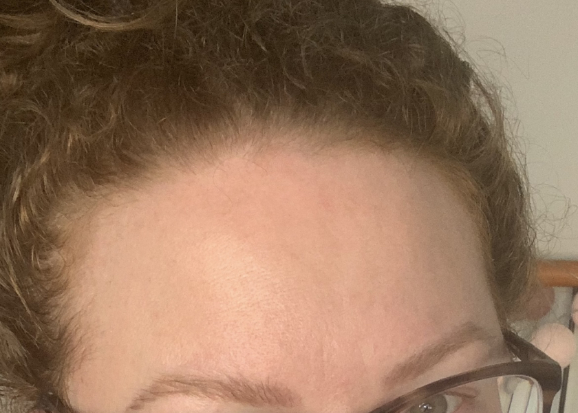 To ask your alternatives to Botox?