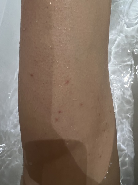 Is this Scabies…?