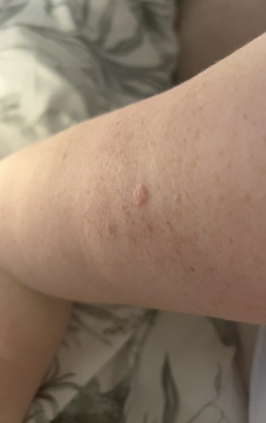 Is this a mole?